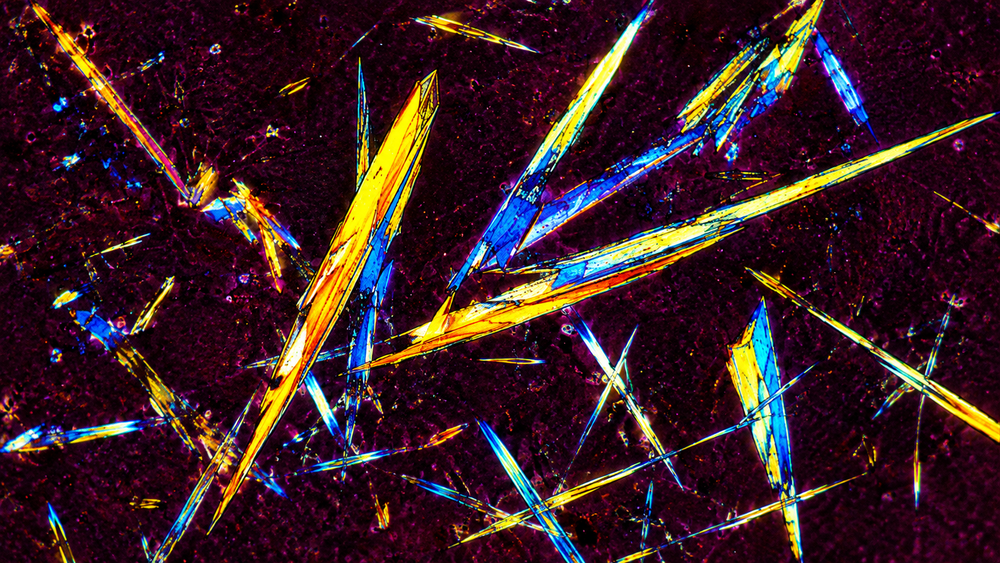 Uric acid crystals under a polarized-light microscope: sharp yellow and blue needle-shaped shards on a dark purple background